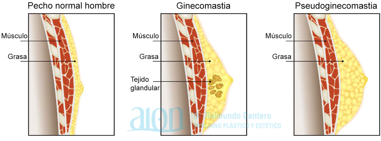 ginecomastia pseudoginecomastia diferencias