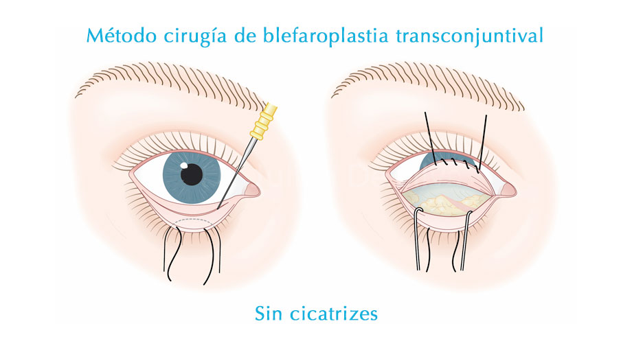 cirugia blefaroplastia transconjuntival
