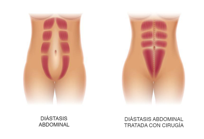 antes y despues cirugia diastasis-abdominal