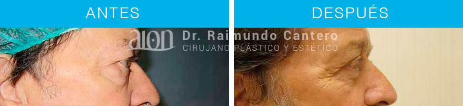 1-1-blefaroplastia-antes-despues