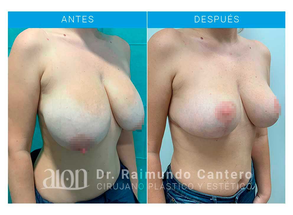 MRCP-semiperfil-antes-despues-reconstruccion-senos-raimundo-cantero