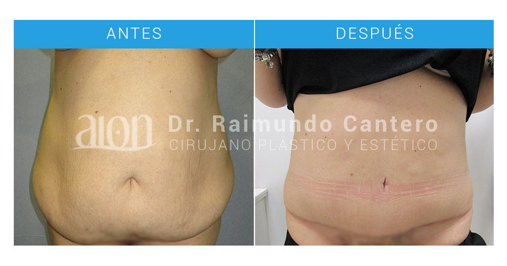 abdominoplastia-en-malaga-doctor-raimundo-cantero