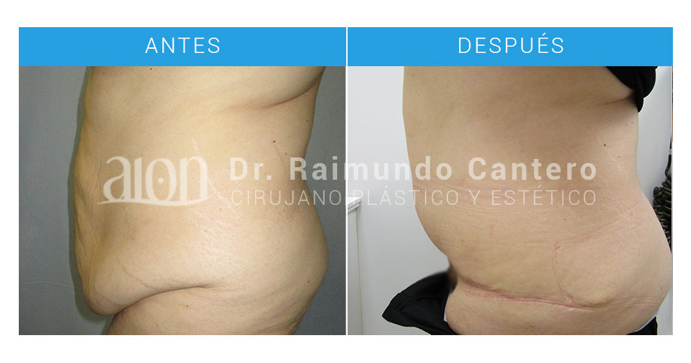 abdominoplastia-malaga-opiniones-raimundo-cantero