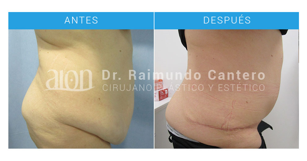 abdominoplastia-malaga-raimundo-cantero