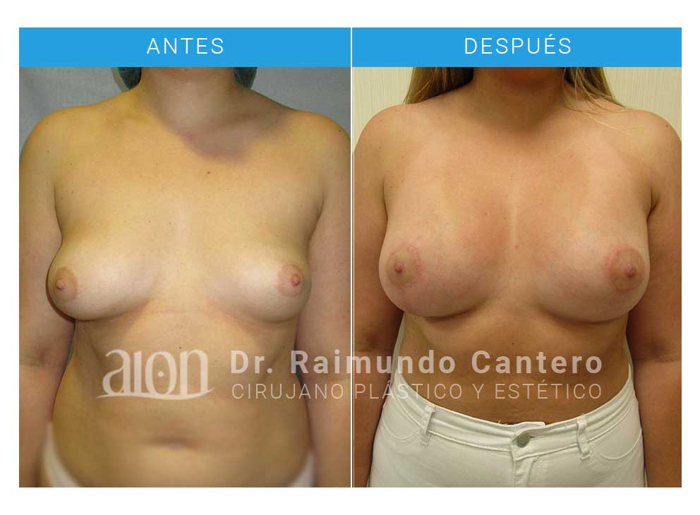 antes-despues-7-reconstruccion-pecho