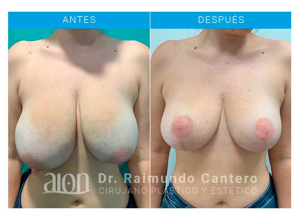 antes-despues-MRCP-frontal-reconstruccion-mamaria-raimundo-cantero