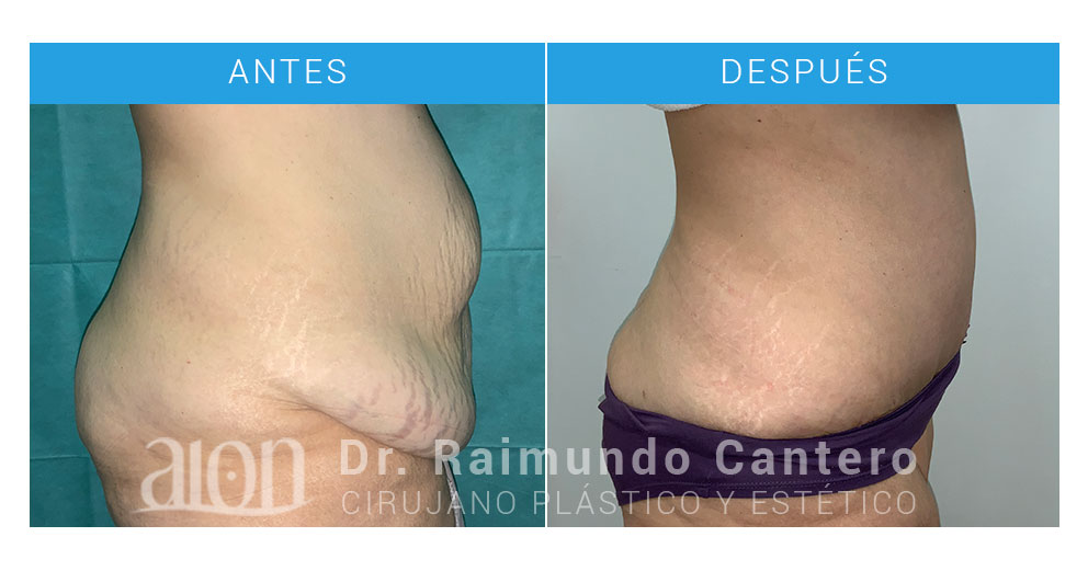 antes-despues-abdominoplastia-rm-gm-lado-raimundo-cantero