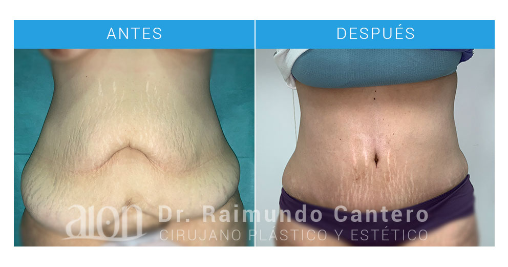 antes-despues-abdominoplastia-rm-gm-raimundo-cantero