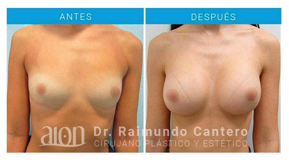 antes-despues-aumento-mamas-anatomicas-en-malaga-dr-raimundo-cantero-new-1