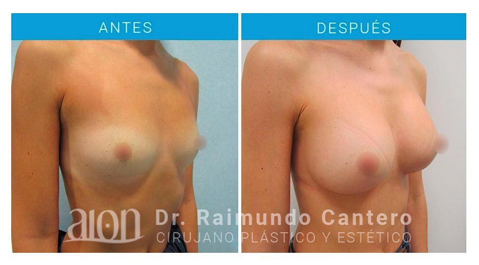 antes-despues-aumento-mamas-anatomicas-en-malaga-dr-raimundo-cantero-new-2