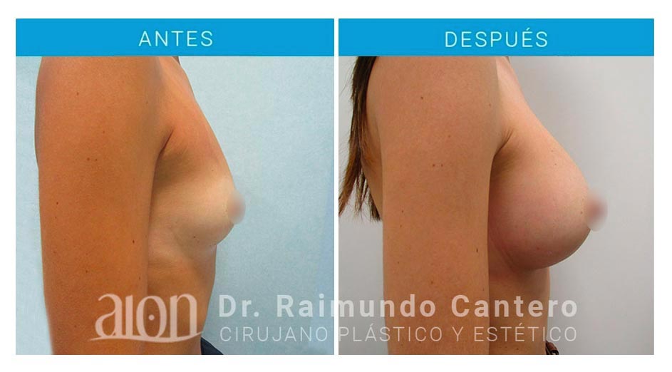 antes-despues-aumento-mamas-anatomicas-en-malaga-dr-raimundo-cantero-new-3