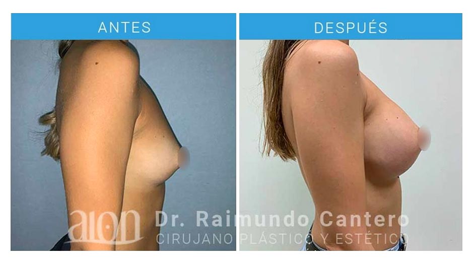 antes-despues-aumento-mamas-en-malaga-dr-raimundo-cantero-new-2