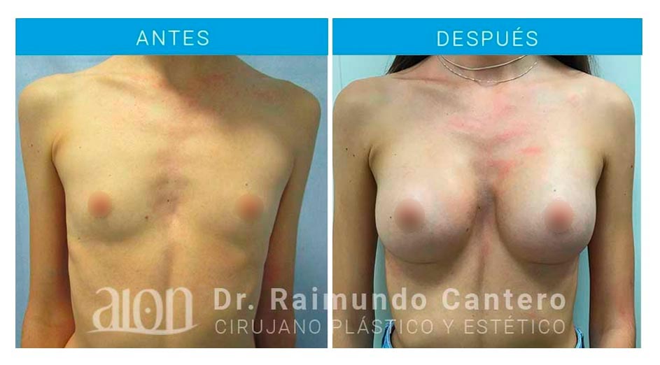 antes-despues-aumento-pecho-anatomicas-nov-19-new-dr-raimundo-cantero-1
