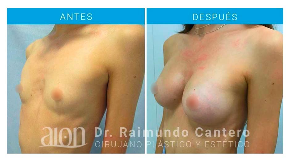 antes-despues-aumento-pecho-anatomicas-nov-19-new-dr-raimundo-cantero-3