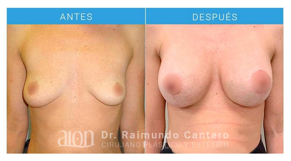 antes-despues-elevacion-raimundo-cantero-LPR-frontal-new