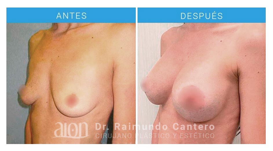 antes-despues-elevacion-raimundo-cantero-LPR-lado-new