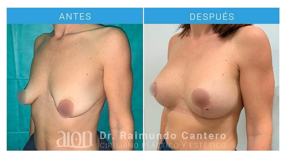 antes-despues-implantes-retropectorales-redondos-mastopexia-mamas