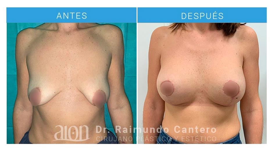 antes-despues-implantes-retropectorales-redondos-mastopexia-pecho