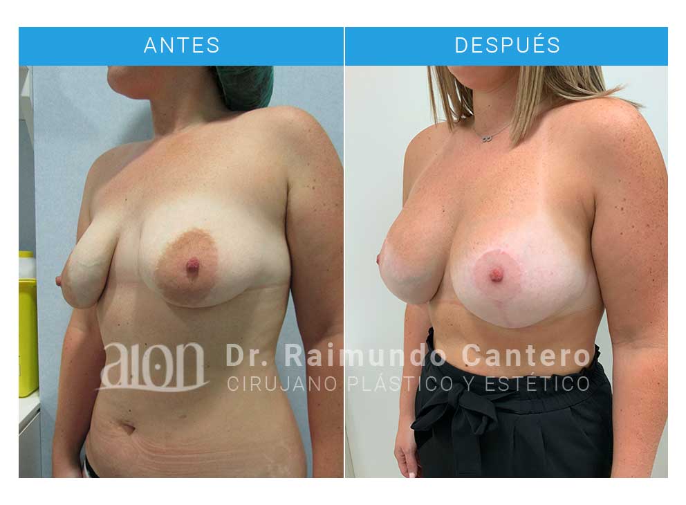 antes-despues-maga3-reconstruccion-pecho