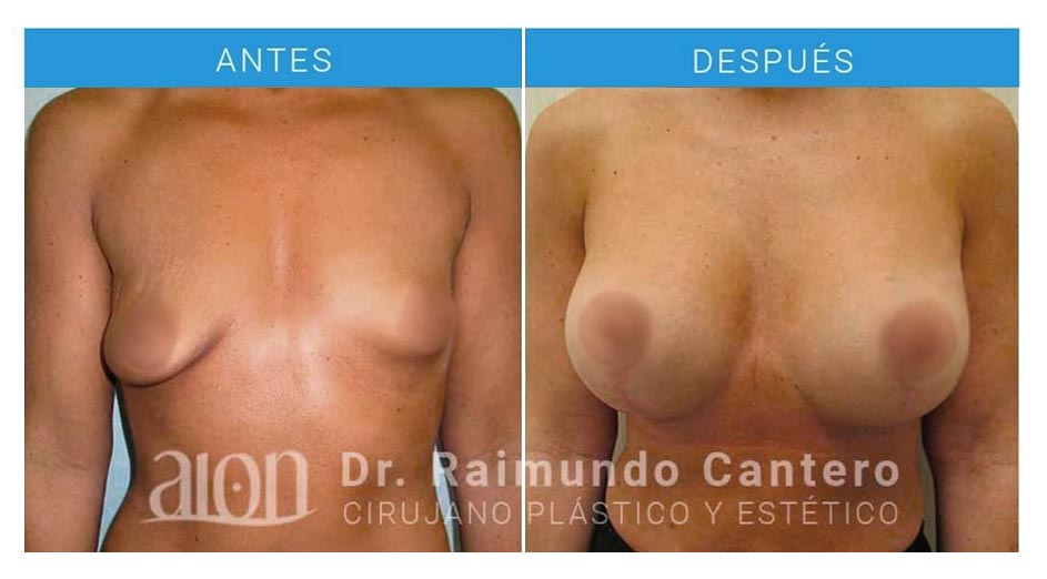 antes-despues-mastopexia-asimetria-raimundo-cantero-1