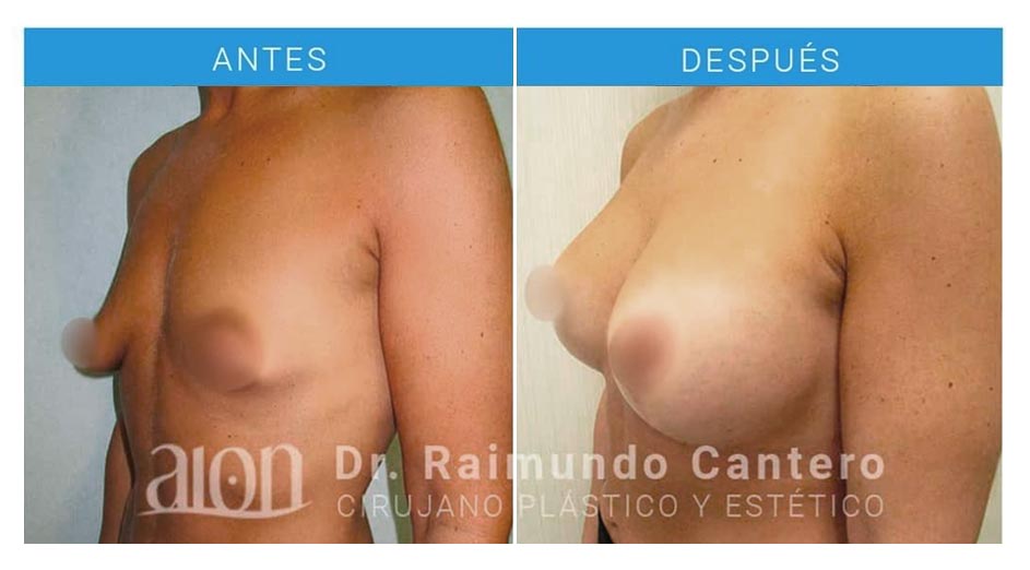 antes-despues-mastopexia-asimetria-raimundo-cantero-2