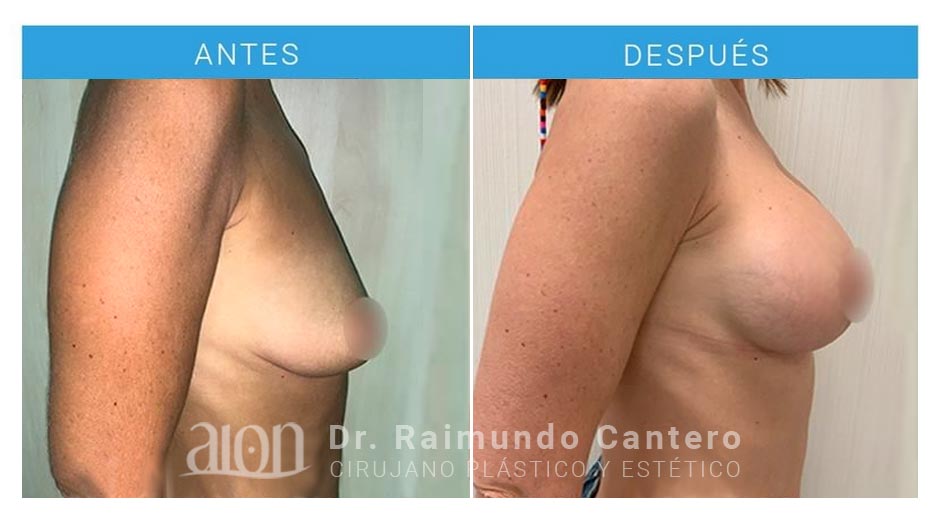 antes-despues-mastopexia-elevacion-vertical-pecho