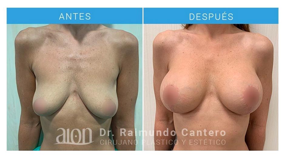 antes-despues-mastopexia-elevacion-vertical