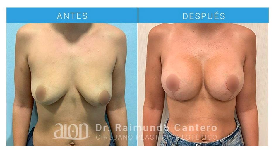 antes-despues-mastopexia-raimundo-cantero-frontal-new