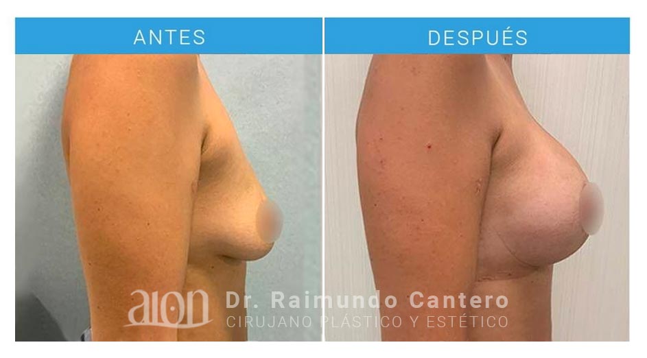 antes-despues-mastopexia-raimundo-cantero-lateral-2-new