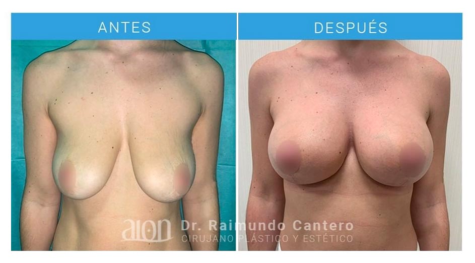 antes-despues-mastopexia-t-raimundo-cantero-1