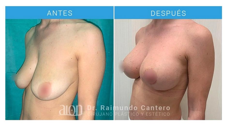 antes-despues-mastopexia-t-raimundo-cantero-2