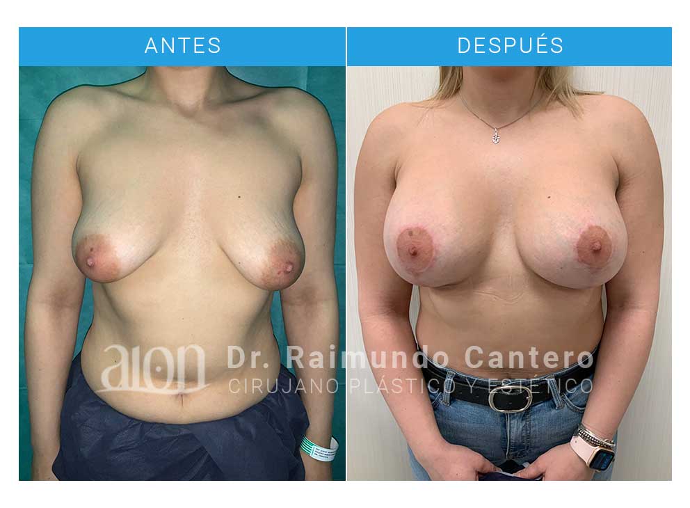 antes-despues-reconstrucción-mama-tuberosa-tbg-raimundo-cantero