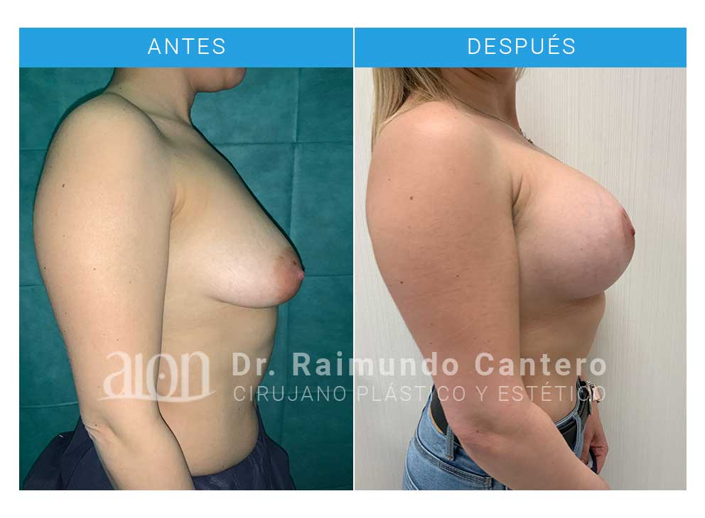 antes-despues-reconstrucción-mama-tuberosa-tbg2-raimundo-cantero