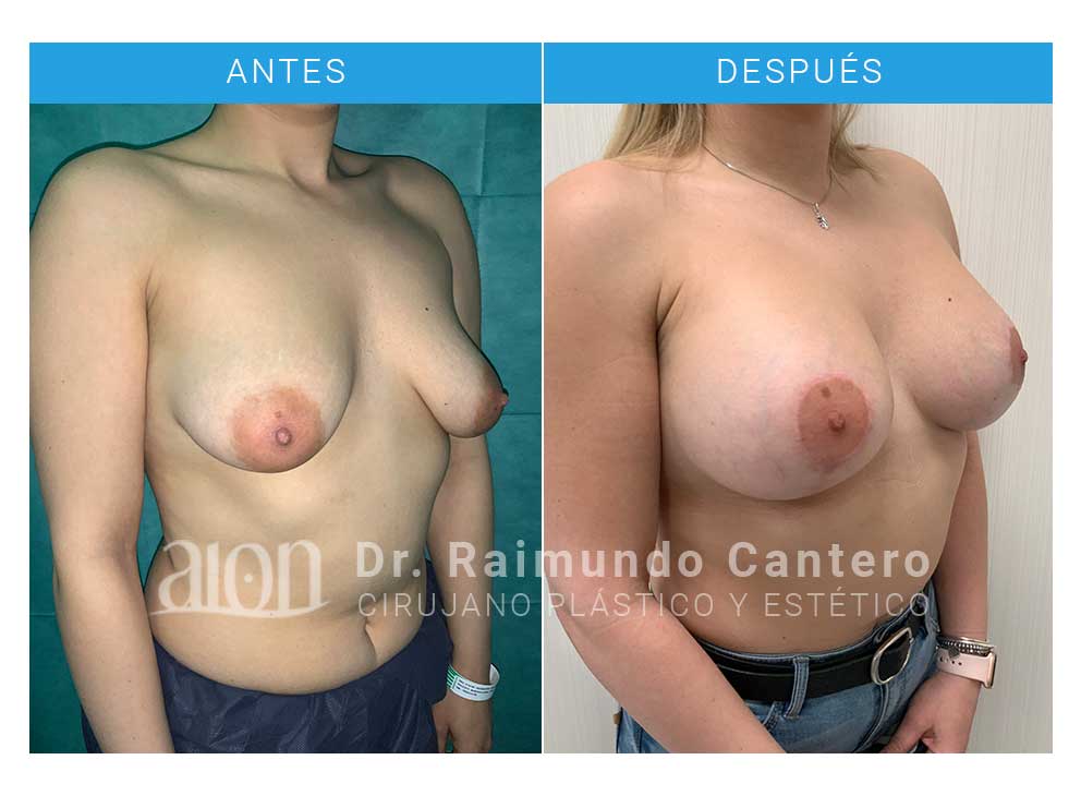 antes-despues-reconstrucción-mama-tuberosa-tbg3-raimundo-cantero