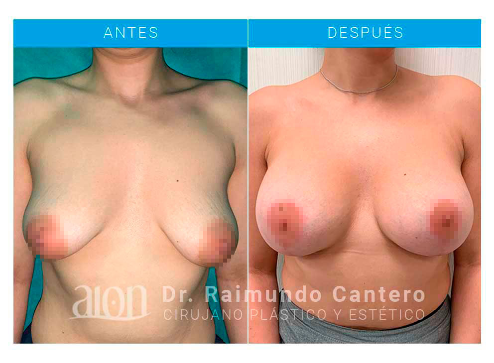 antes-despues-reconstruccion-raimundo-cantero-TBL-frontal-D