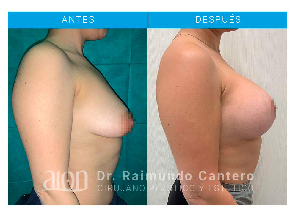 antes-despues-reconstruccion-raimundo-cantero-TBL-perfil-dcho