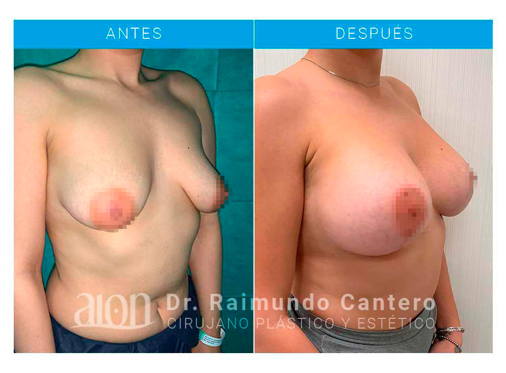 antes-despues-reconstruccion-raimundo-cantero-TBL-semiperfil-dcho