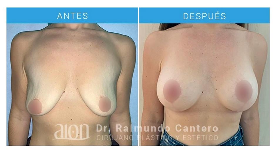 antes-y-despues-mastopexia-raimundo-cantero-3-new