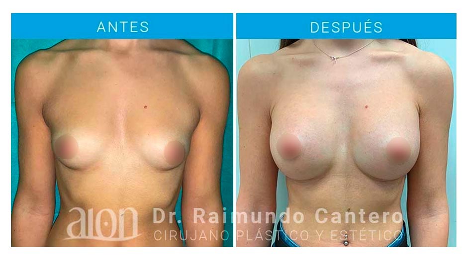 aumento-de-mamas-antes-despues-redondas-protesis-raimundo-cantero-new-1