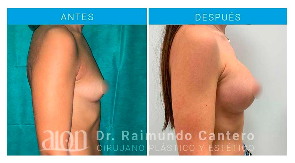 aumento-de-mamas-antes-despues-redondas-protesis-raimundo-cantero-new-2