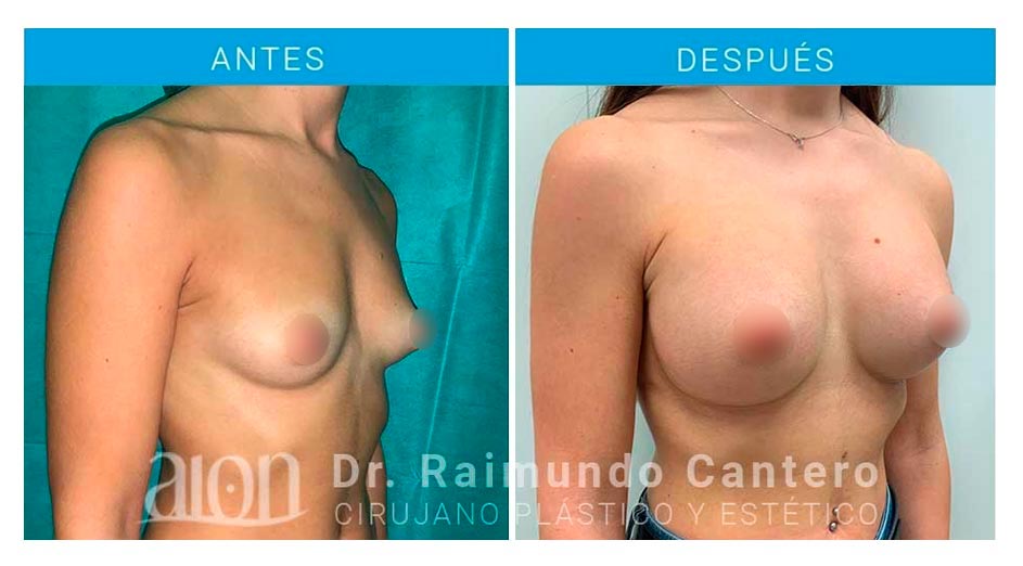 aumento-de-mamas-antes-despues-redondas-protesis-raimundo-cantero-new-3