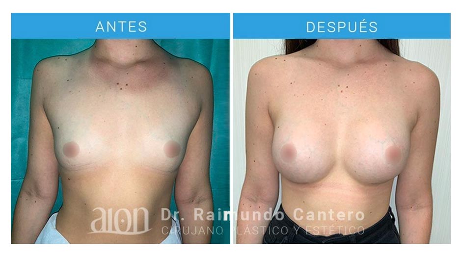 aumento-de-pecho-protesis-redondas-dr-raimundo-cantero-7-1-new