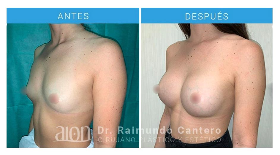 aumento-de-pecho-protesis-redondas-dr-raimundo-cantero-7-2-new
