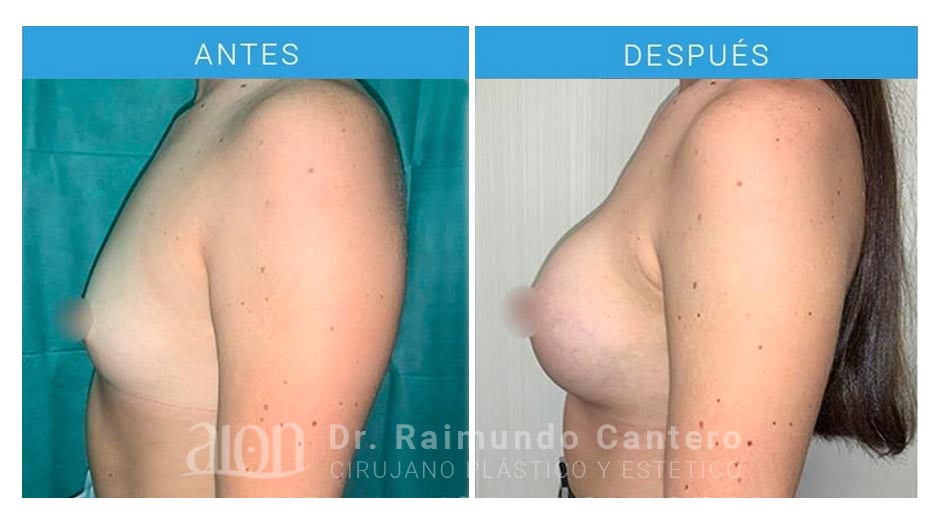 aumento-de-pecho-protesis-redondas-dr-raimundo-cantero-7-3-new