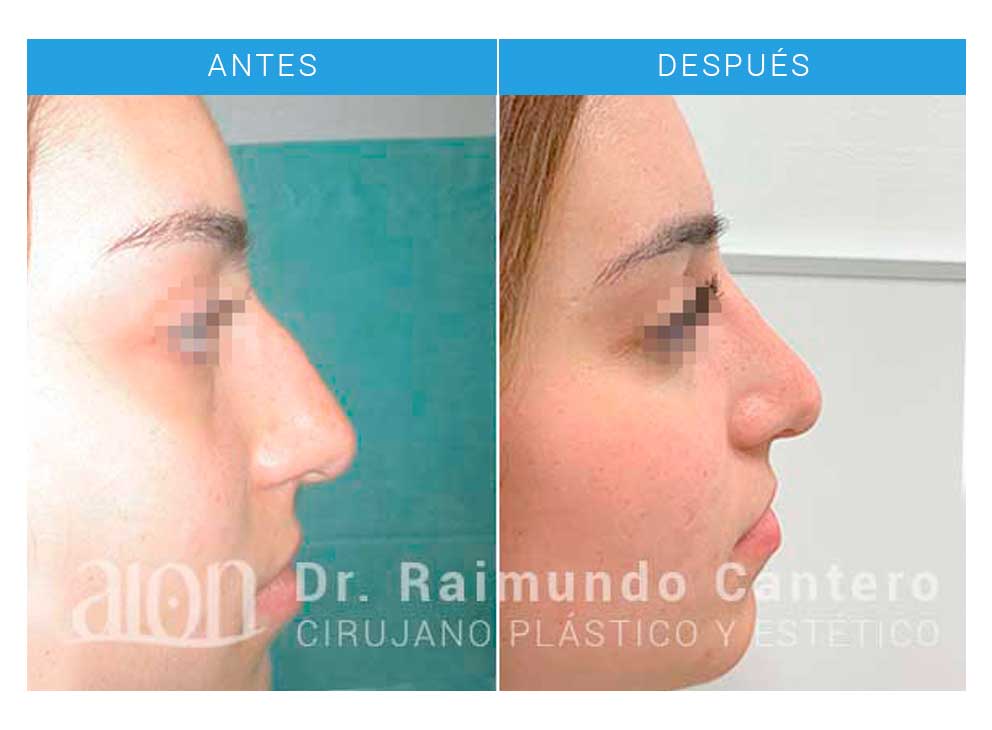 cirujano plastico rinoplastia malaga