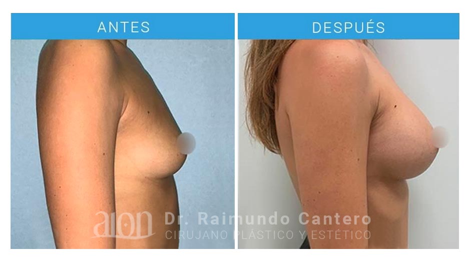 cirugia-implantes-anatomicos-aumento-pecho-new-2