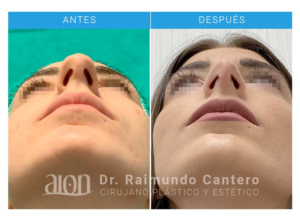 cirugía-rinoplastia-antes-despues-raimundo-cantero-2