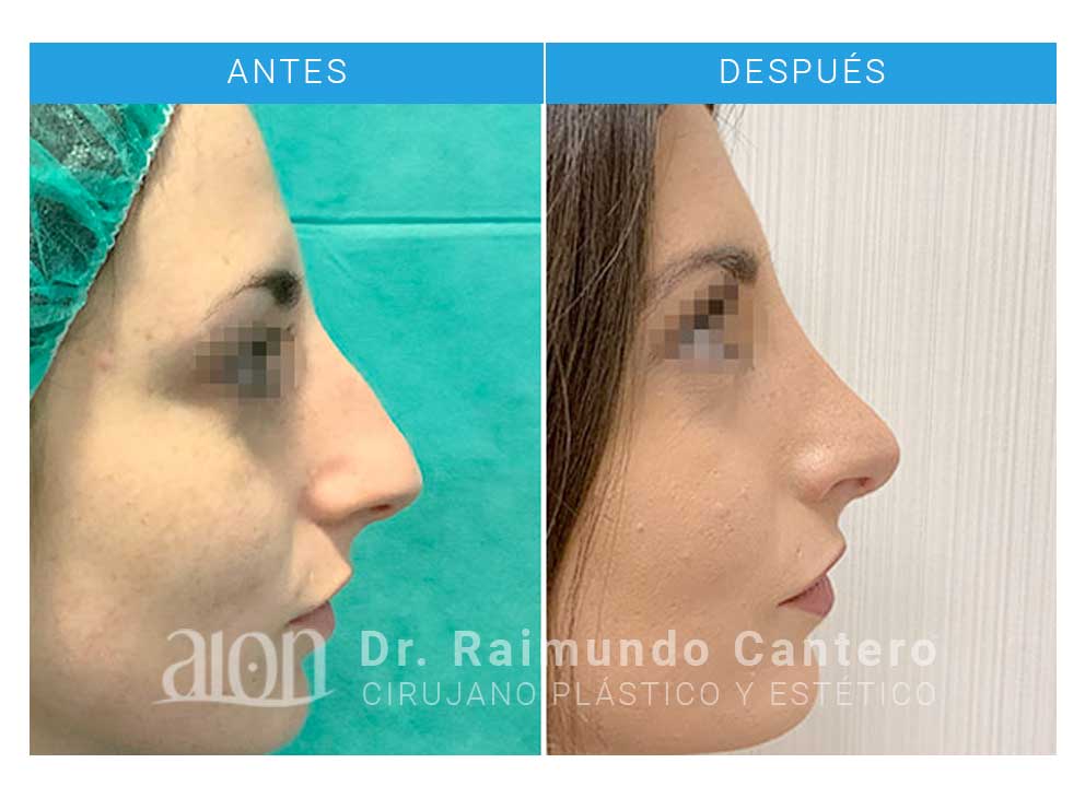 cirugía-rinoplastia-antes-despues-raimundo-cantero