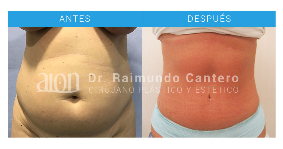 ejemplo-frontal-abdominoplastia-en-malaga