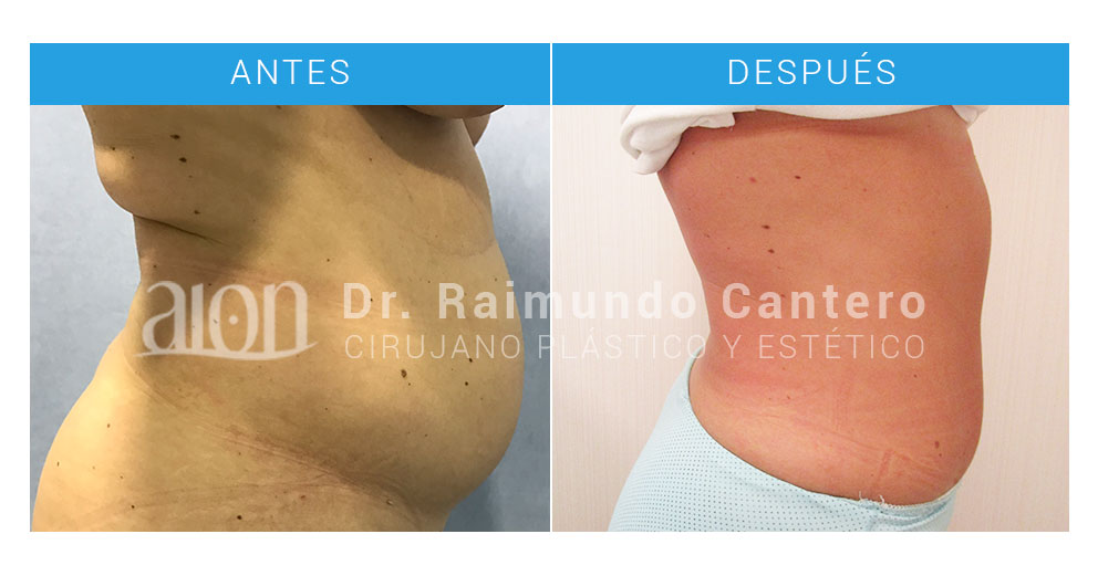 ejemplo-perfil-abdominoplastia-malaga